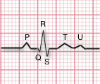 EKG-oneBeat.png